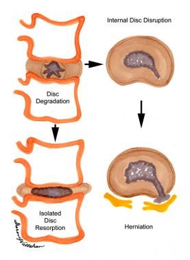 The process of disk degeneration following interna