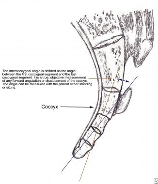 Coccyx is usually formed of 3-5 rudimentary verteb