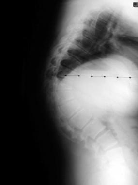 Preoperative lateral of a patient with an 85° thor