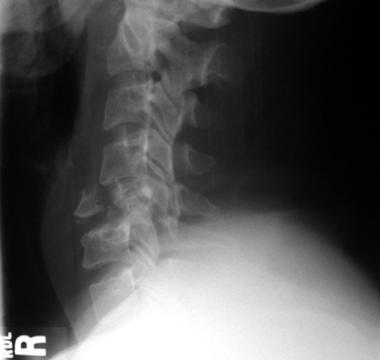 Lateral film of a C5 burst/teardrop fracture. 