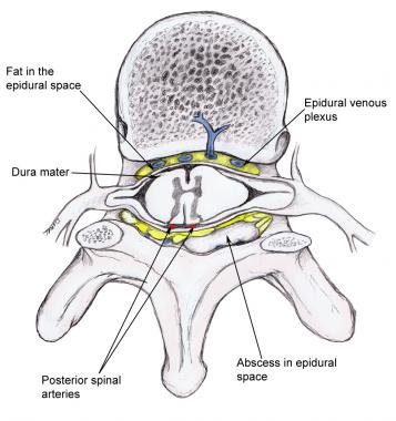 Abscess that compresses the spinal cord and its va