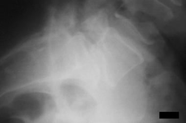 Spondylolisthesis, spondylolysis, and spondylosis.