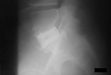 Spondylolisthesis, spondylolysis, and spondylosis.