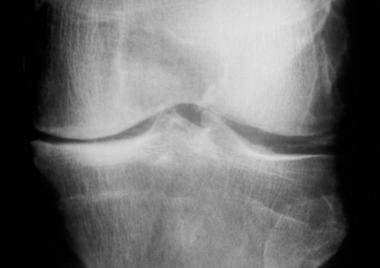 Calcium pyrophosphate deposition disease. Radiogra