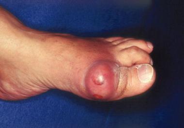Gout. Acute podagra due to gout in elderly man. 