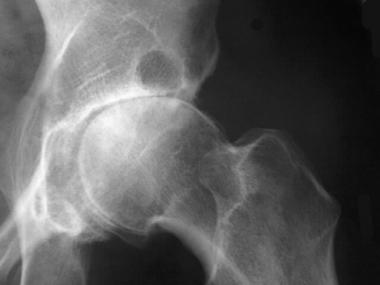 This radiograph demonstrates osteoarthritis of the