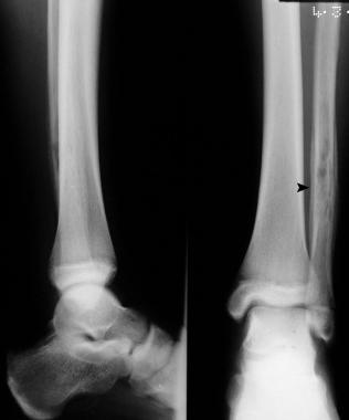 Rarefaction and periosteal new-bone formation arou