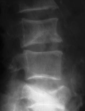 Osteoporosis of the spine. Note the lateral wedge 