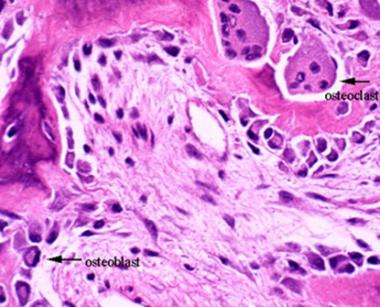 This image depicts bone remodeling with osteoclast