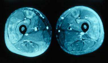 MRI of thighs showing increased signal in the quad