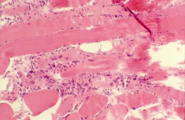 Histopathology of polymyositis showing endomysial 