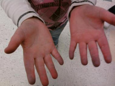 A 9-year-old with Raynaud phenomenon. Notice the d