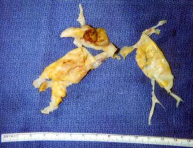 Pulmonary embolism within the pulmonary artery. 