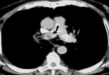 Helical CT scan of the pulmonary arteries. A filli