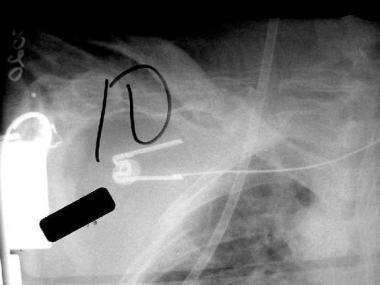 Traumatic brachial plexus injury. Initial anteropo