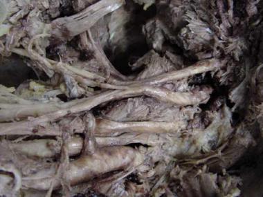 Traumatic brachial plexus injury. Human cadaveric 