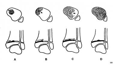 (A) The distal tibial growth plate begins to close