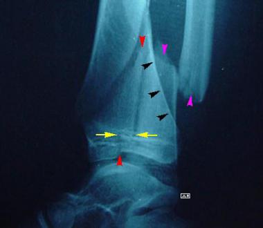 Lateral radiograph of a triplane fracture illustra