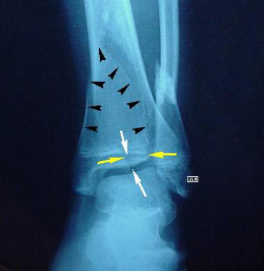 Radiograph of a triplane fracture. The anterior-po