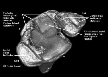 Digital 3-dimensional helical CT scan reconstructi