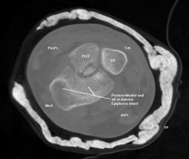 Two-dimensional helical CT scan image prior to 3-d