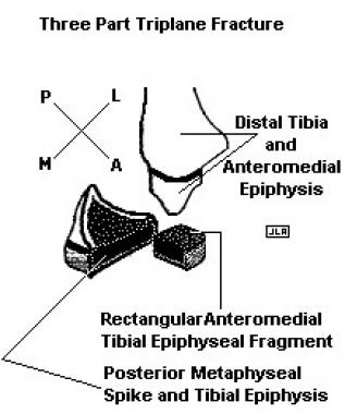 In a 3-part triplane fracture, the 3 fracture line