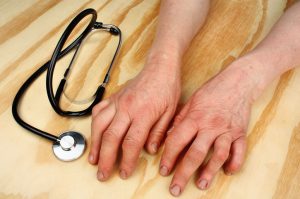 New biologic drug for rheumatoid arthritis approved by the FDA