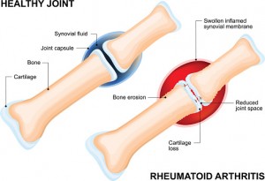 Vagus nerve stimulation eases arthritis: Study
