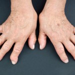 psoriatic arthritis vs. rheumatoid arthritis