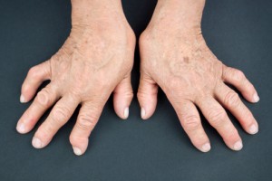psoriatic arthritis vs. rheumatoid arthritis