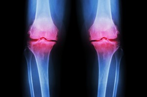 Osteoarthritis severity same as rheumatoid arthritis