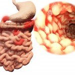 Crohn’s disease, ulcerative colitis progression and development linked to “creeping fat”