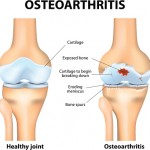 gout and osteoarthritis