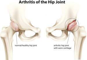 Osteoarthritis of the hip (hip arthritis) causes pain and may be invisible on x-ray