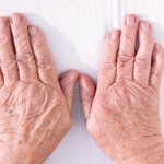 Early signs of arthritis in the hands