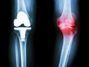 Osteoarthritis