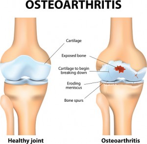 osteoarthritis vs osteoporosis