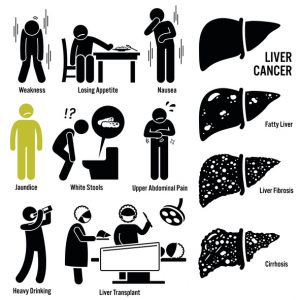Liver Cancer Symptoms Transplant Illustrations