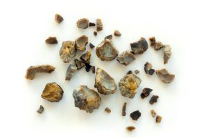 Kidney stone risk higher in patients with ankylosing spondylitis: Study