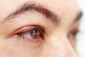 chalazion lump on the eyelid