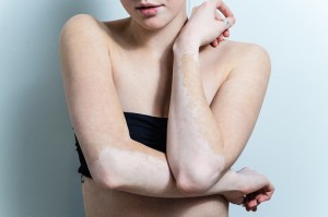 Psoriasis vs. vitiligo