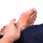 Gout treatment