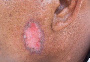 psoriasis ringworm