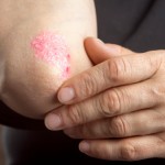 Severe-psoriasis