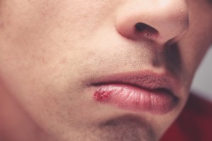 Psoriasis and cold sores, the most stigmatized skin disorders: Study
