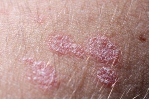 Psoriasis increases erectile dysfunction risk in men