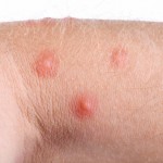 pimples on skin