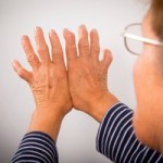 Manage rheumatoid arthritis 