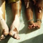 Vitiligo symptoms