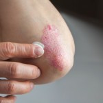 Treating psoriasis and eczema